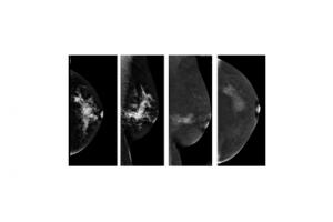 Контрастная спектральная маммография на системе Senographe Essential